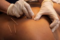 dry needling acupuncture
