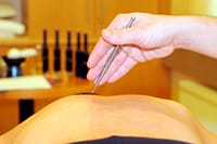experienced acupuncturist in carlsbad
